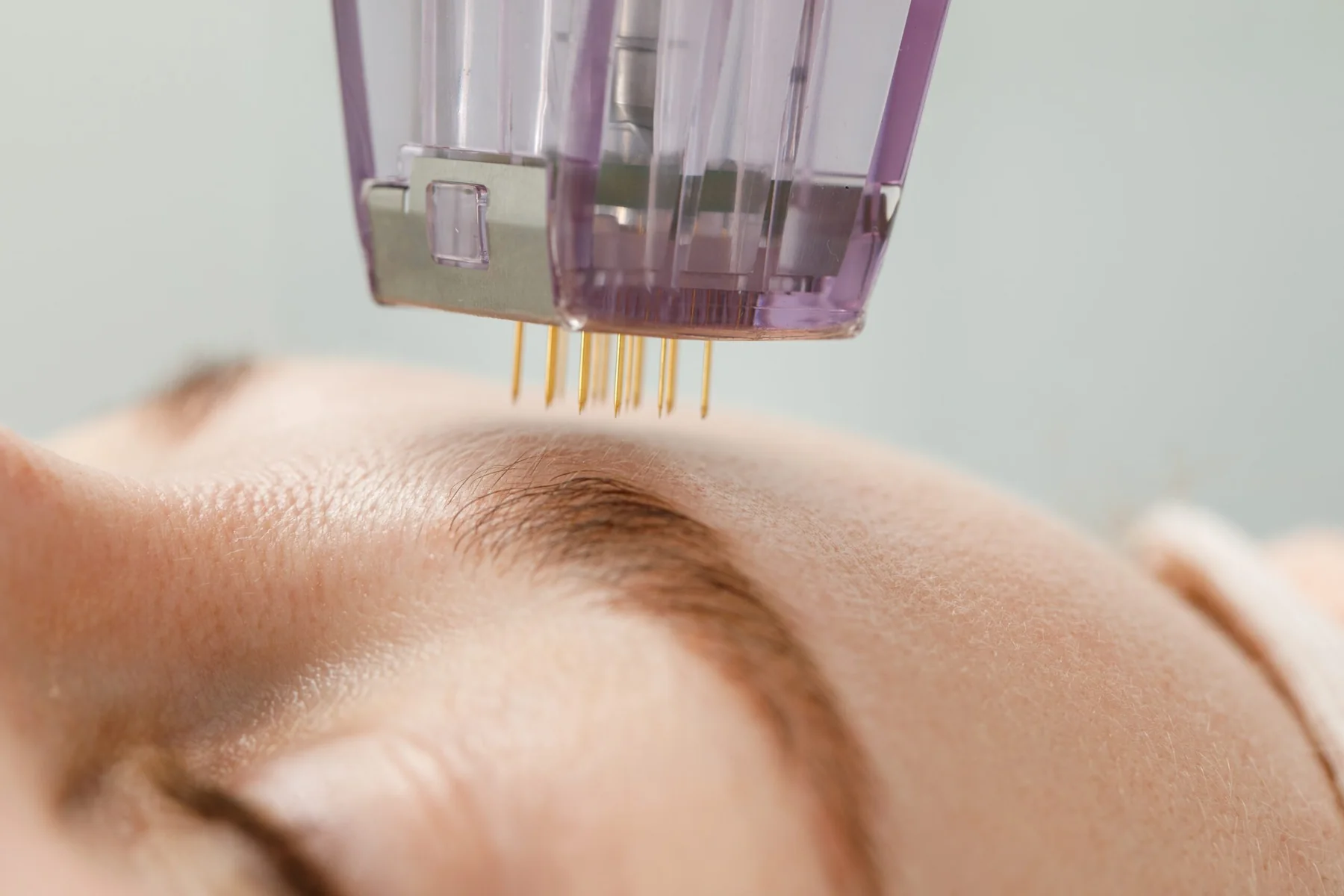 Woman face with microneedle going into her forehead.