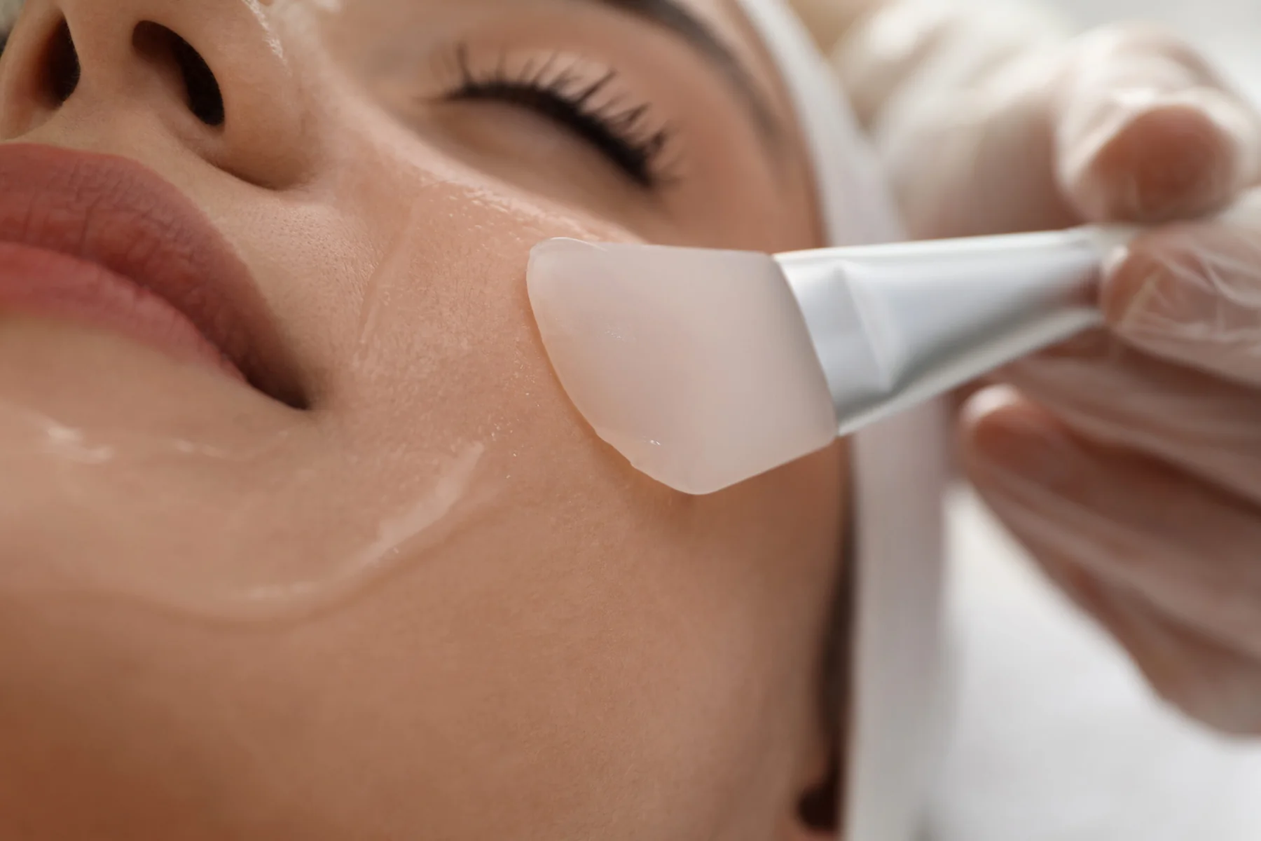 Tips for Enhancing Chemical Peel Outcomes in Arlington, TX