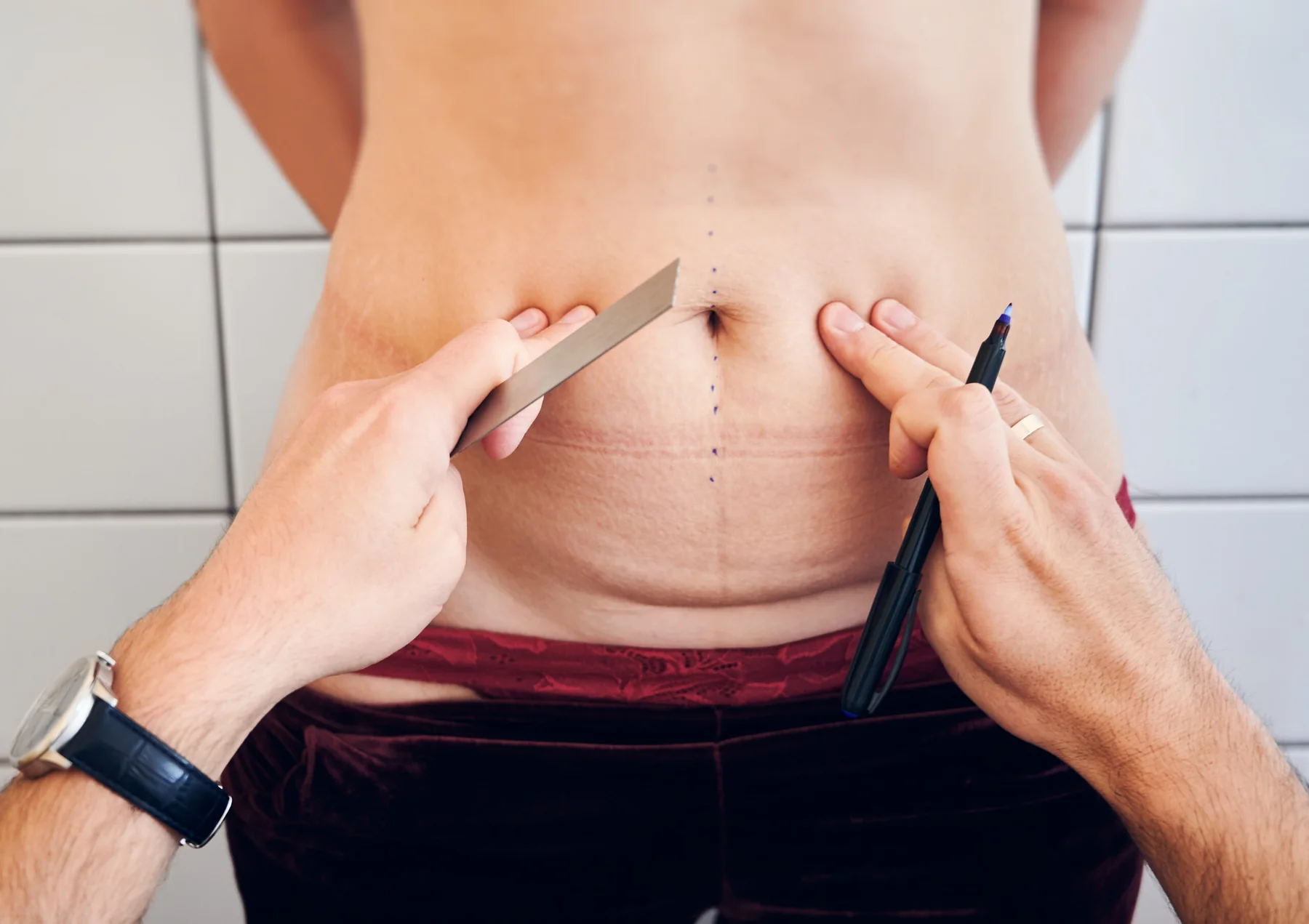 Embrace the New Year with a Transformative Tummy Tuck in Fort Worth