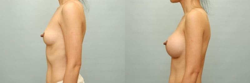 Breast augmentation before and after result, case 04