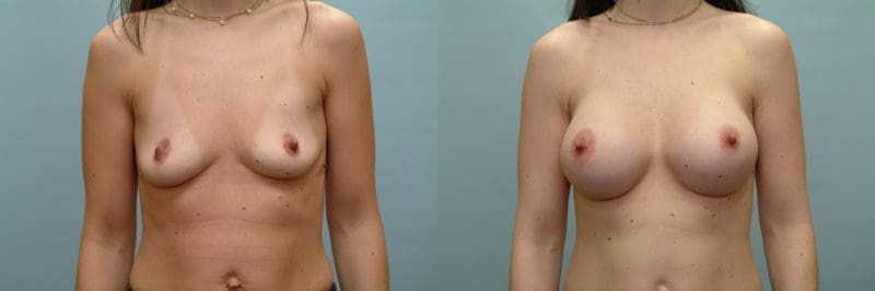 Breast augmentation before and after result, case 05