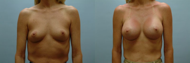 Breast augmentation before and after result, case 09