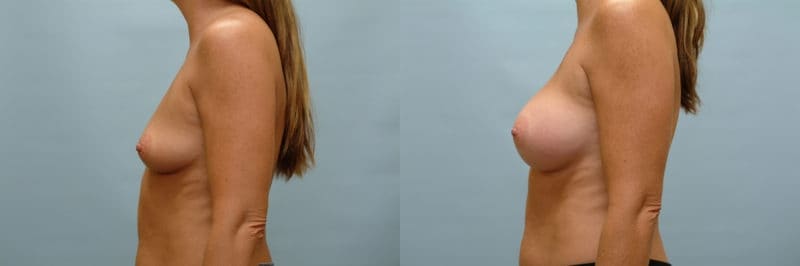 Breast augmentation before and after result, case 10