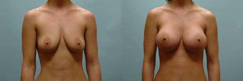 Breast augmentation before and after result, case 11