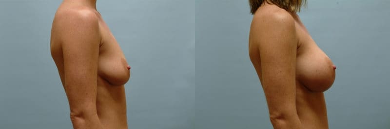 Breast augmentation before and after result, case 12