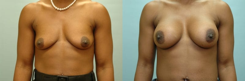 Breast augmentation before and after result, case 13