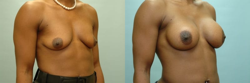 Breast augmentation before and after result, case 14