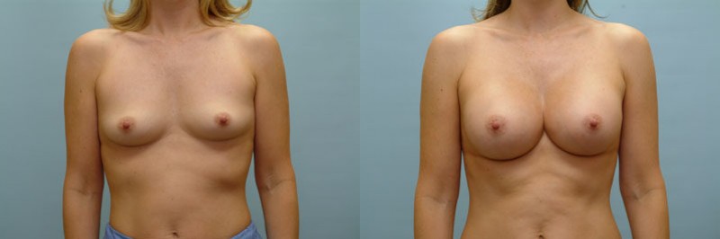 Breast augmentation before and after result, case 15