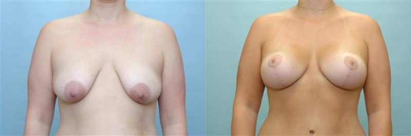 Breast lift + augmentation before and after result, case 03