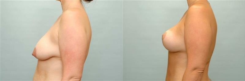 Breast lift + augmentation before and after result, case 04