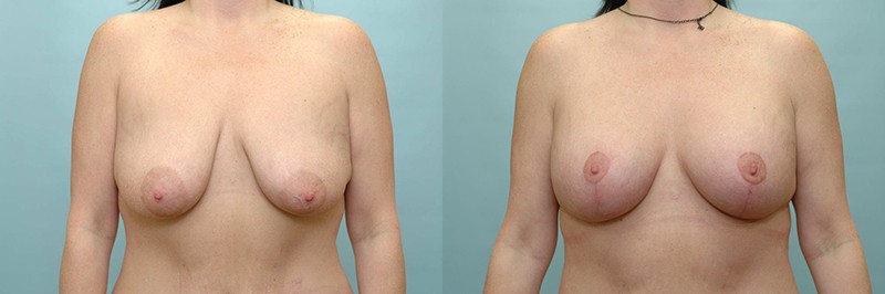 Breast lift + augmentation before and after result, case 07