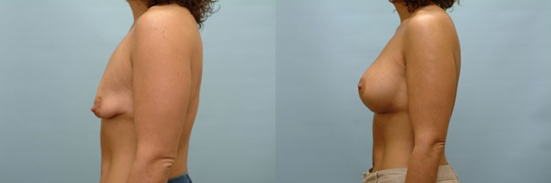 Breast lift + augmentation before and after result, case 10