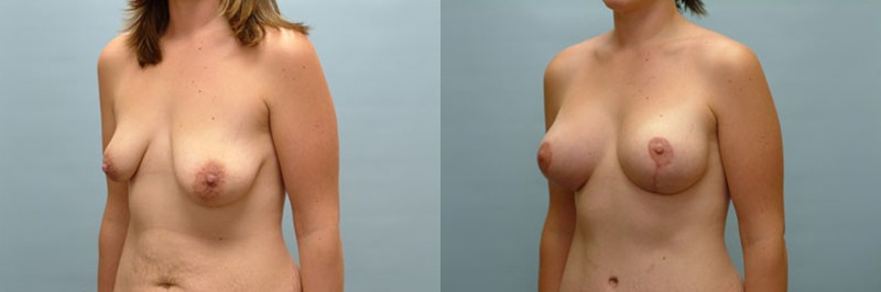 Breast lift + augmentation before and after result, case 12
