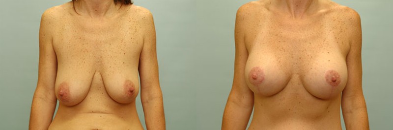 Breast lift + augmentation before and after result, case 15