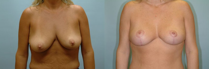 Breast lift only before and after result, case 03