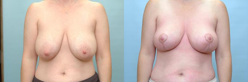 Breast lift only before and after result, case 05