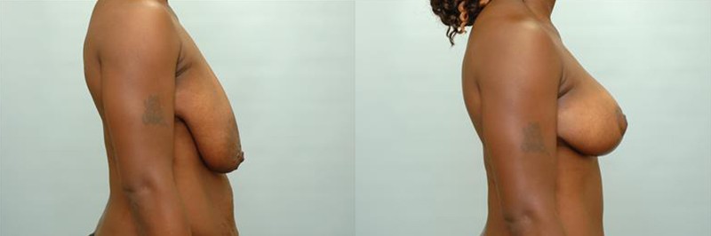 Breast lift only before and after result, case 08