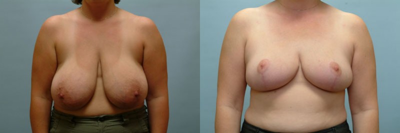 Breast reduction before and after result, case 03