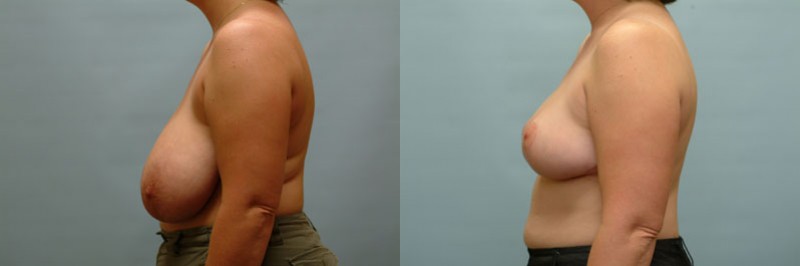 Breast reduction before and after result, case 04