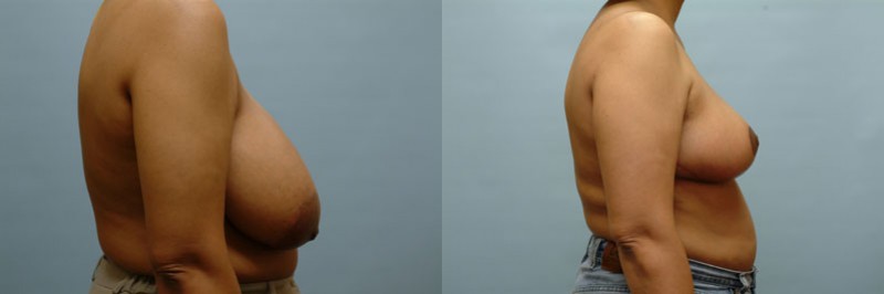 Breast reduction before and after result, case 08