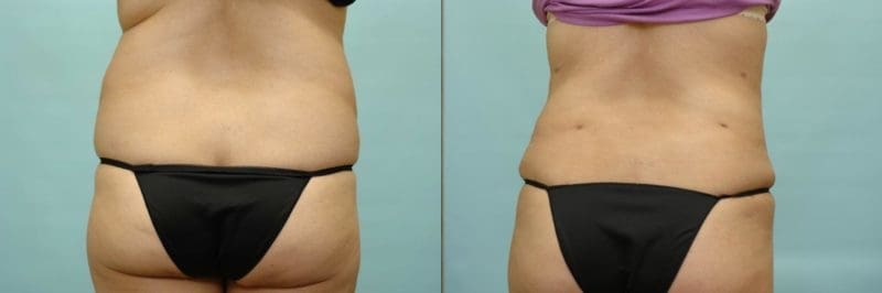 Liposuction before and after result, case 02