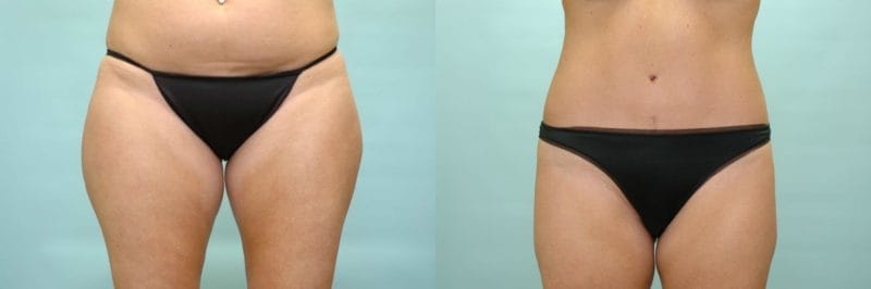 Liposuction before and after result, case 03