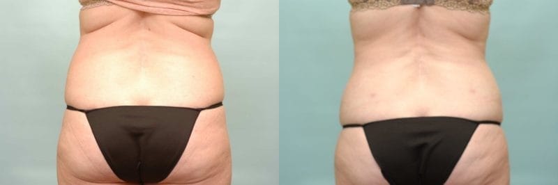 Liposuction before and after result, case 04