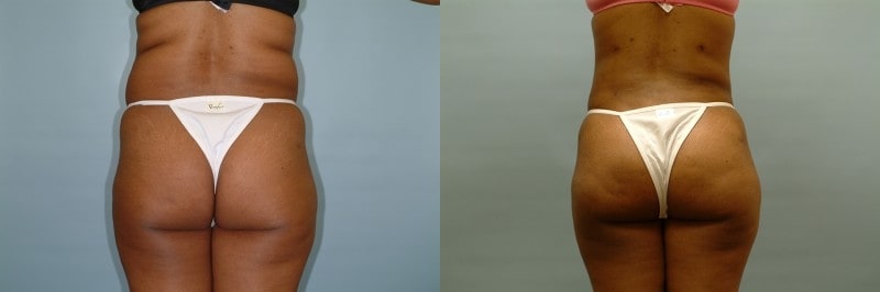 Liposuction before and after result, case 05