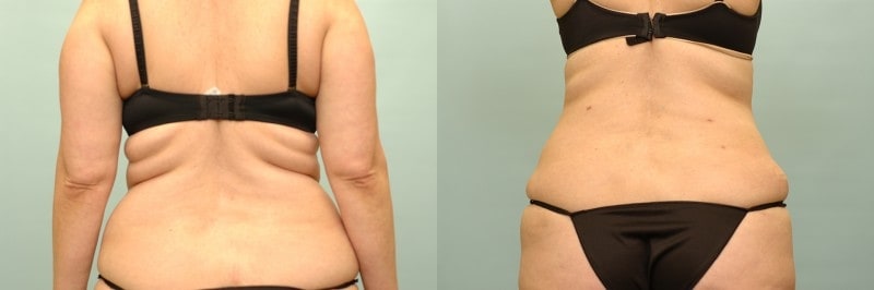 Liposuction before and after result, case 07