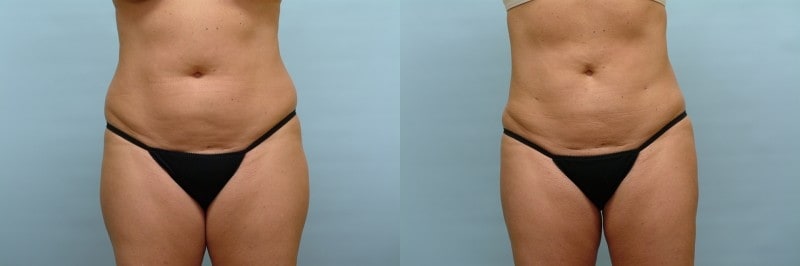 Liposuction before and after result, case 08