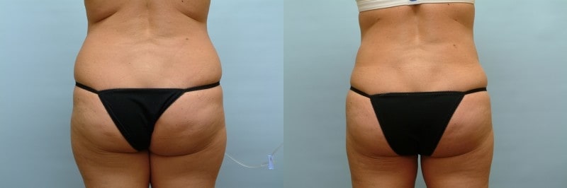 Liposuction before and after result, case 09