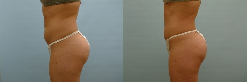 Liposuction before and after result, case 11