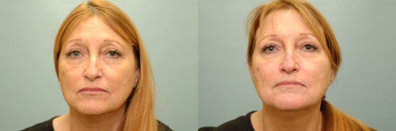 Med Spa treatments before and after result, case 07