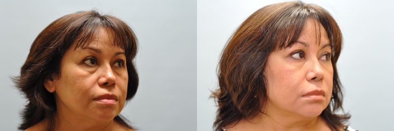 Med Spa treatments before and after result, case 10