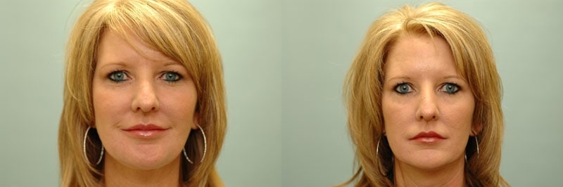 Med Spa treatments before and after result, case 12
