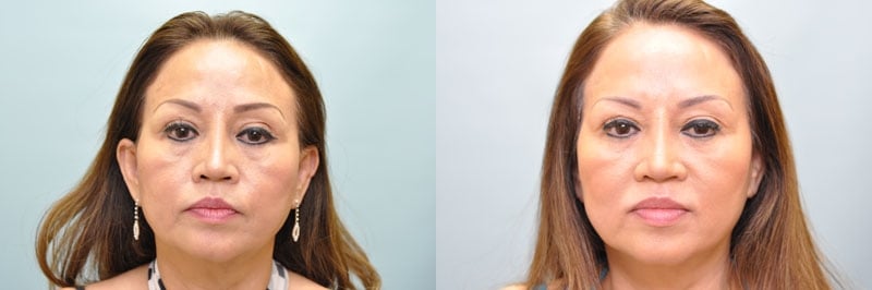 Med Spa treatments before and after result, case 13