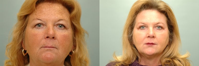 Med Spa treatments before and after result, case 15