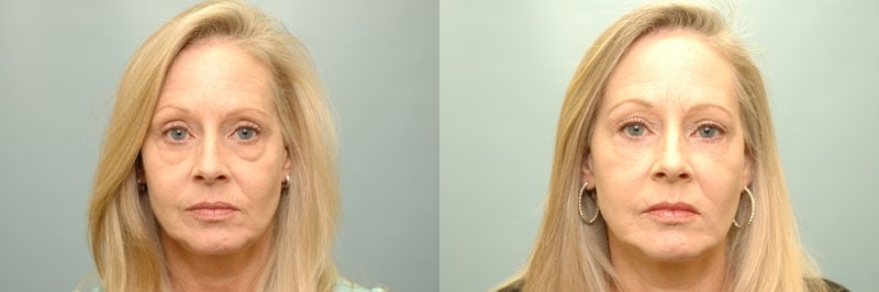 Med Spa treatments before and after result, case 16