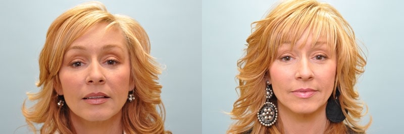 Med Spa treatments before and after result, case 17