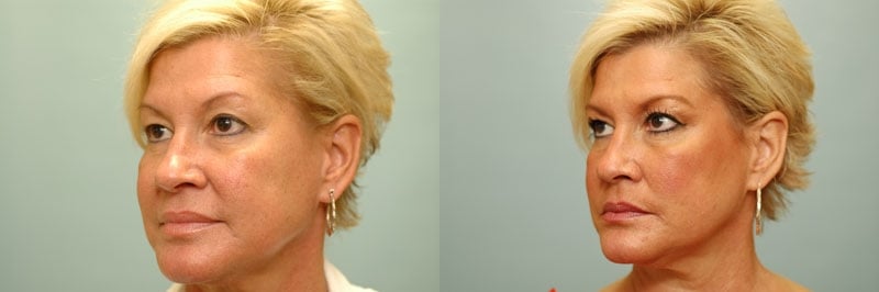 Med Spa treatments before and after result, case 18