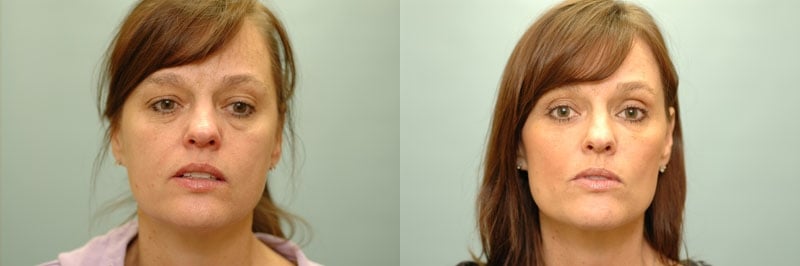 Med Spa treatments before and after result, case 20