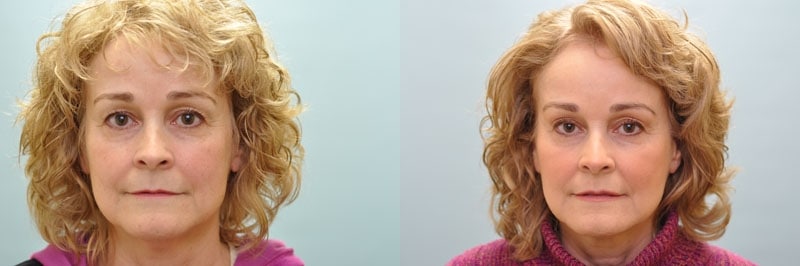 Med Spa treatments before and after result, case 21