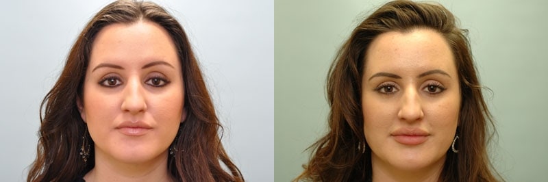 Med Spa treatments before and after result, case 22