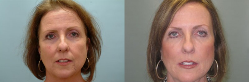 Med Spa treatments before and after result, case 24