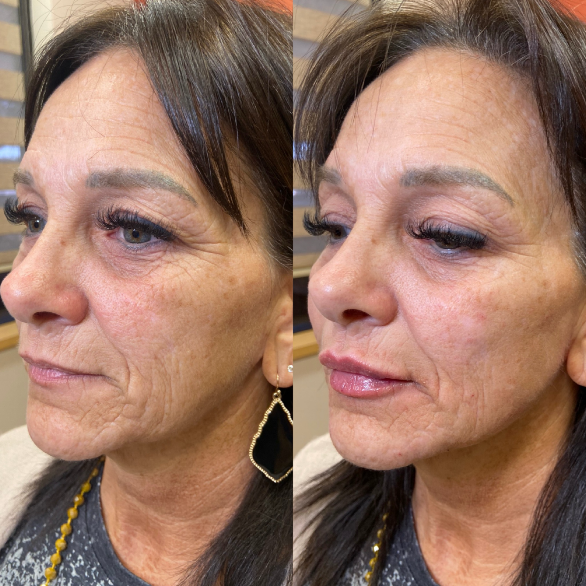 Med Spa treatments before and after result, case 03