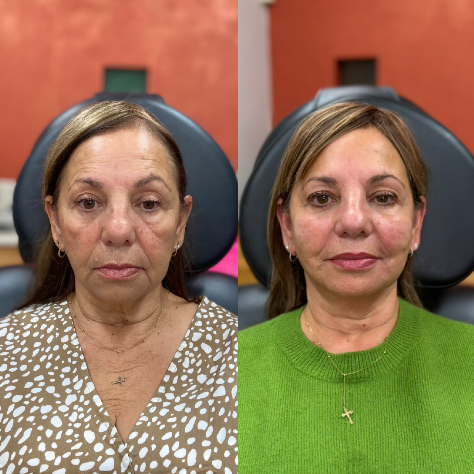 Med Spa treatments before and after result, case 05