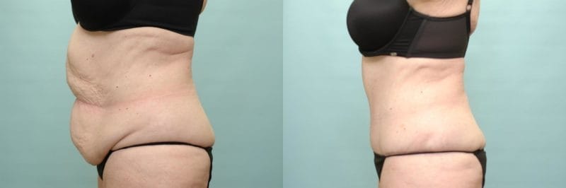 Tummy tuck before and after result, case 04