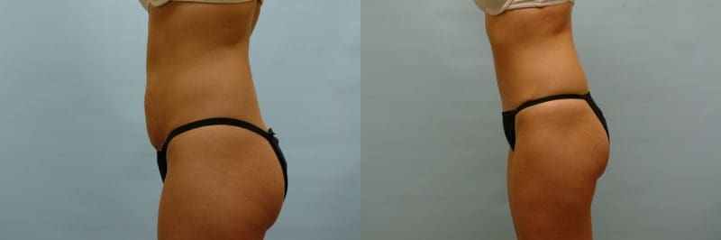 Tummy tuck before and after result, case 06