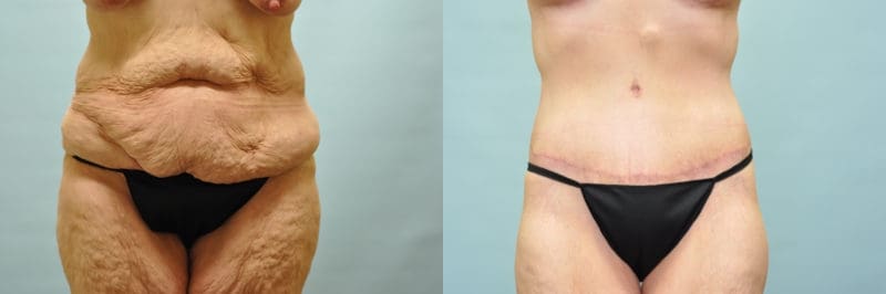 Tummy tuck before and after result, case 07