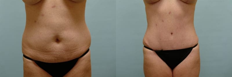 Tummy tuck before and after result, case 09